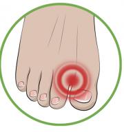 Zaščita ločilnega dela prstov za bunione (hallux valgus)