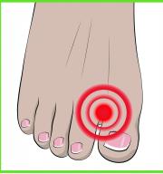 Zaščita ločilnega dela prstov za bunione (hallux valgus) 1 par